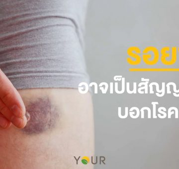 รอยช้ำ