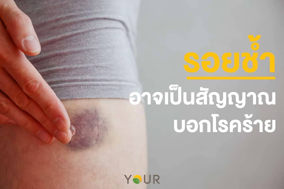 รอยช้ำ