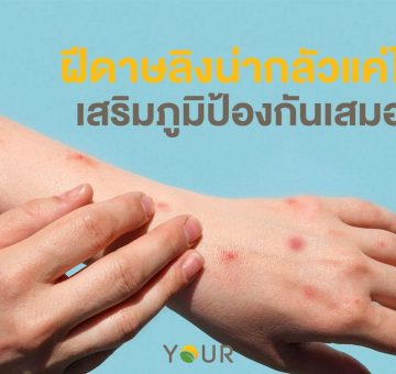 ฝีดาษลิง