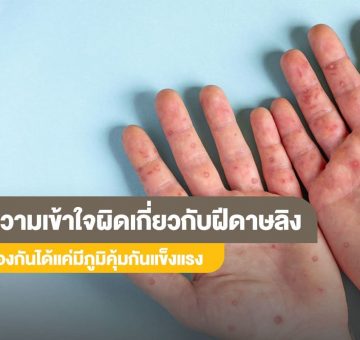 ฝีดาษลิง