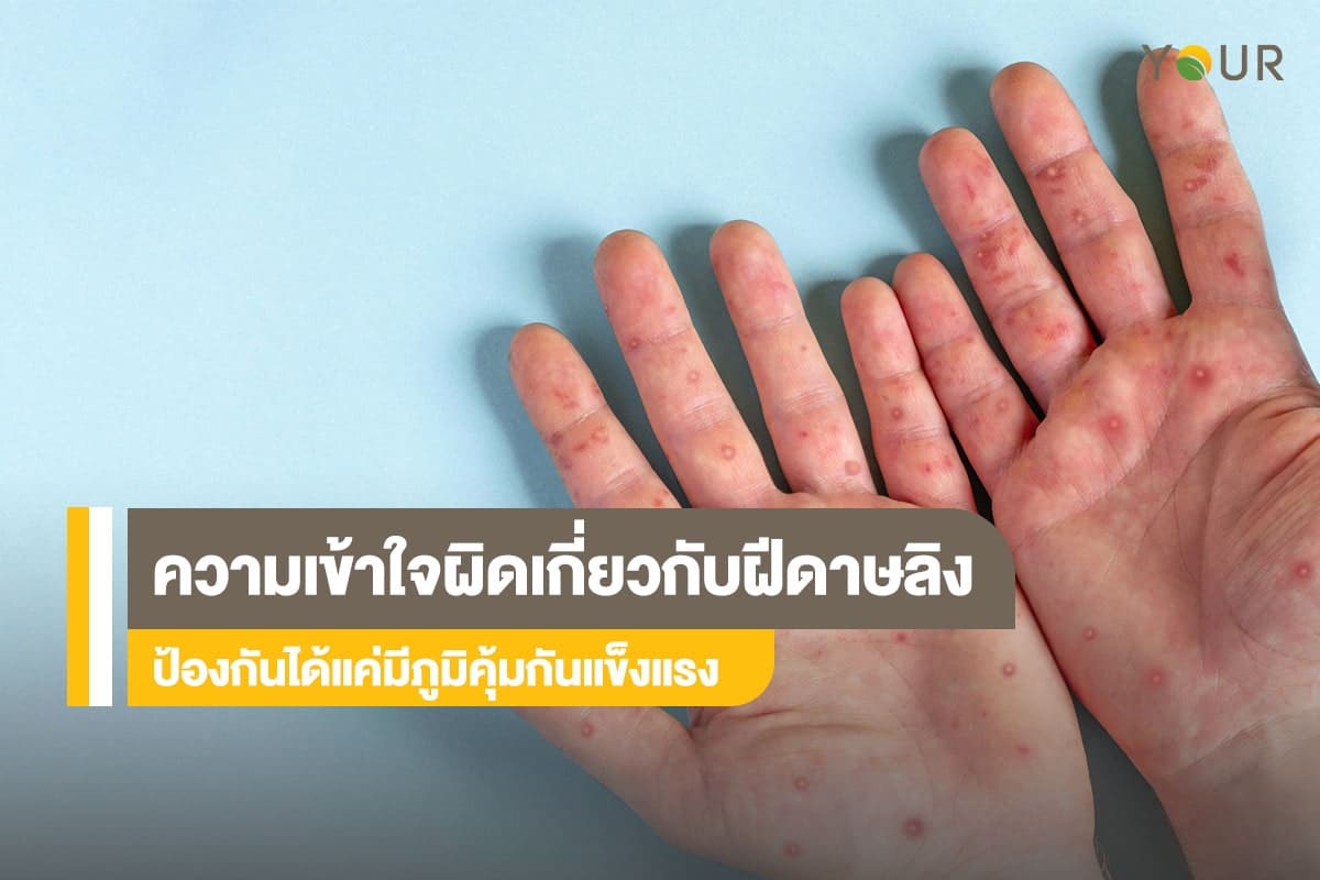 ฝีดาษลิง