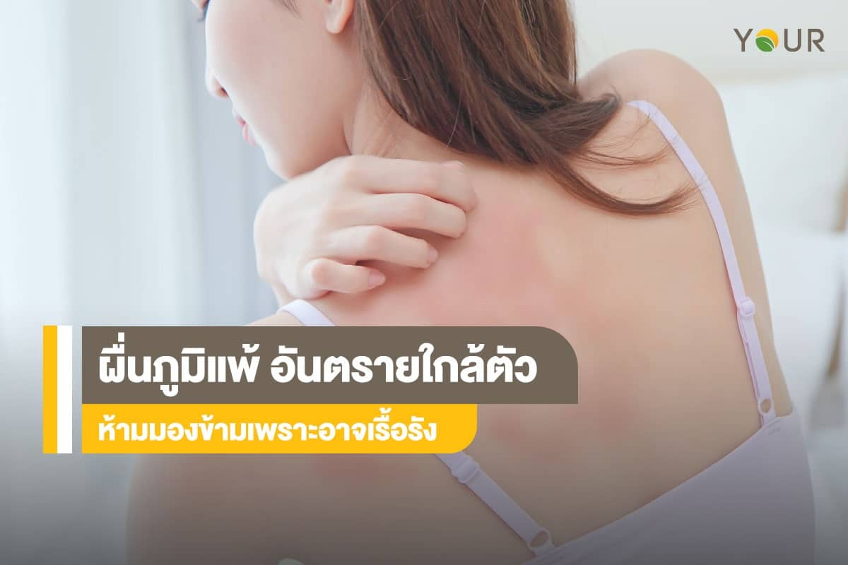 ผื่นภูมิแพ้