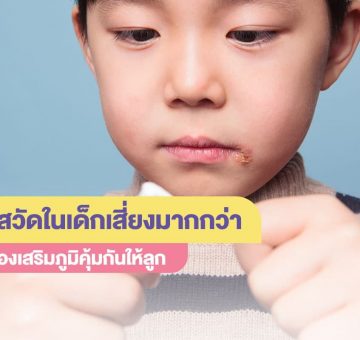 โรคงูสวัด