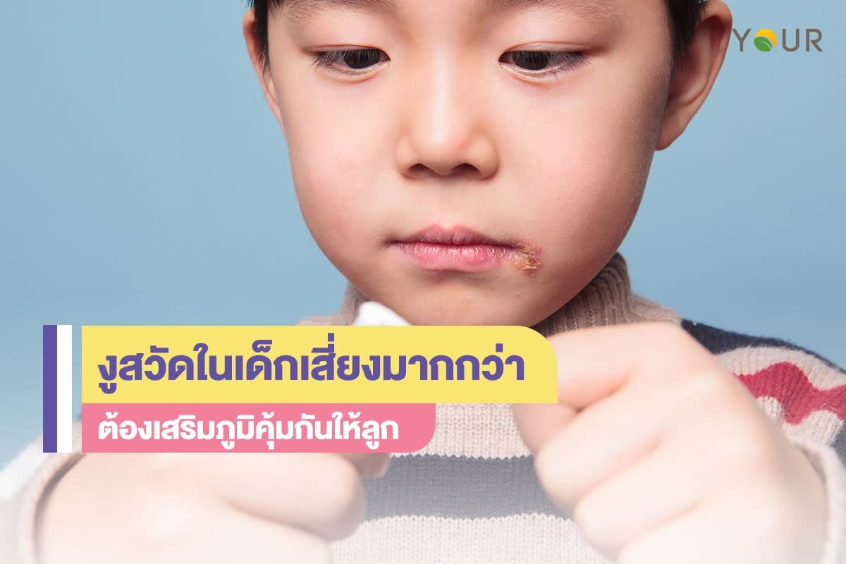 โรคงูสวัด