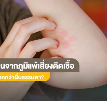 ผื่นจากภูมิแพ้