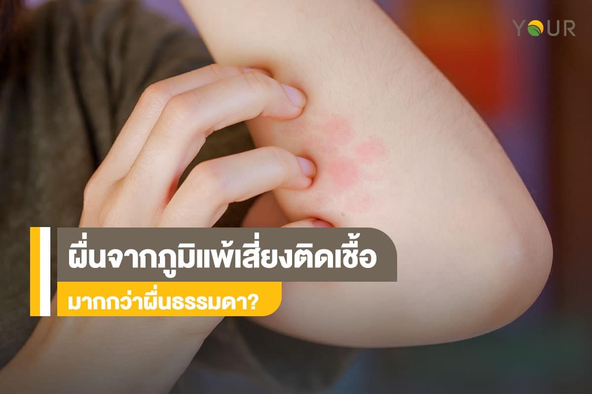 ผื่นจากภูมิแพ้