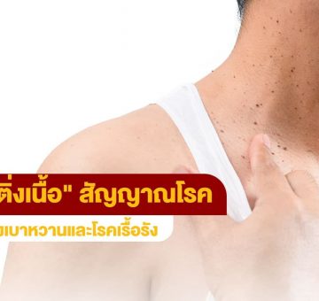 ติ่งเนื้อ