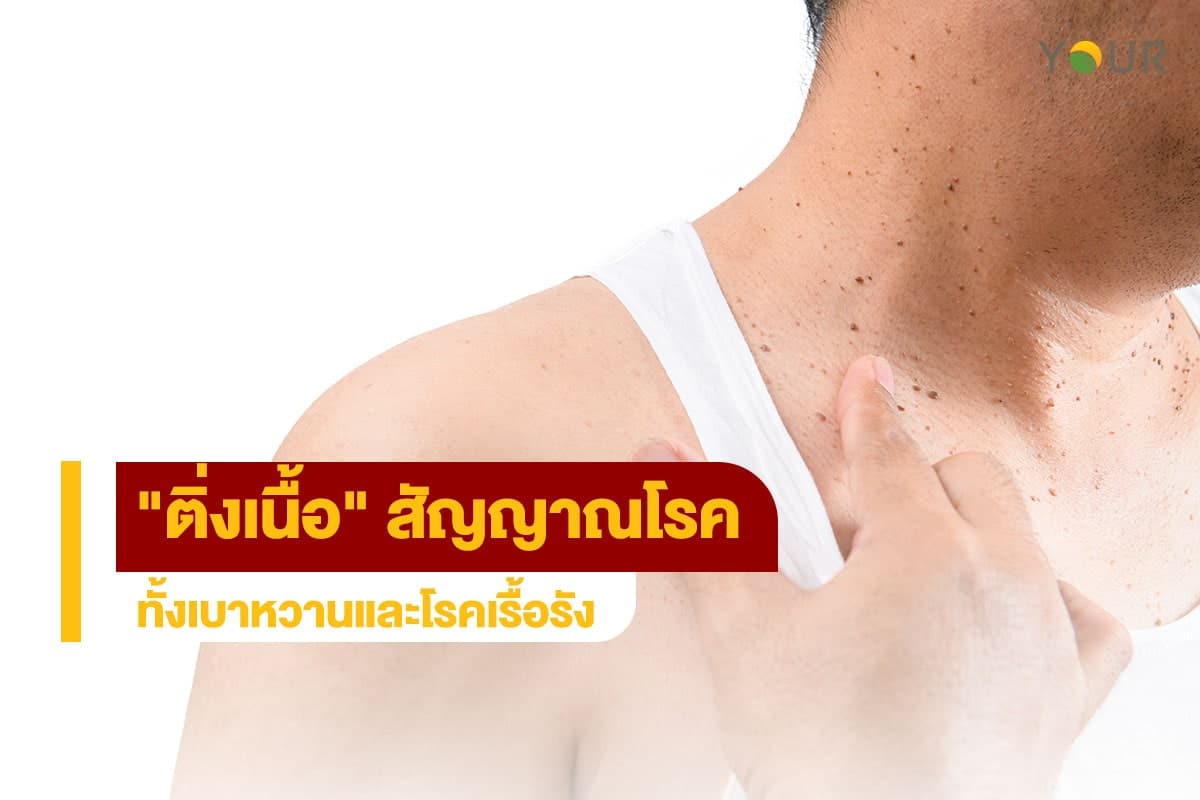ติ่งเนื้อ