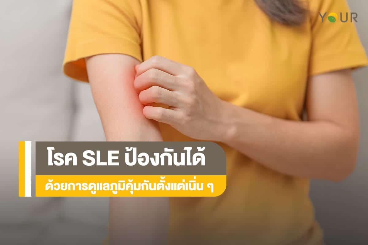 โรค SLE