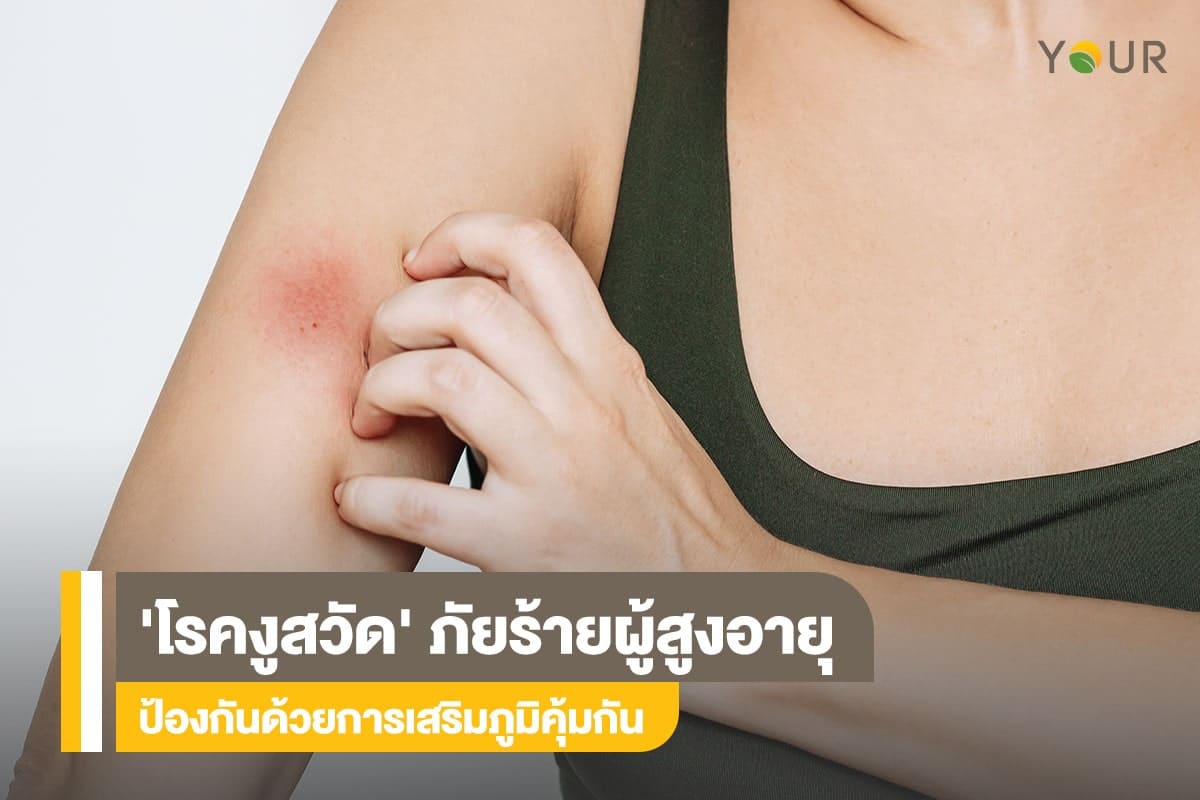 โรคงูสวัด